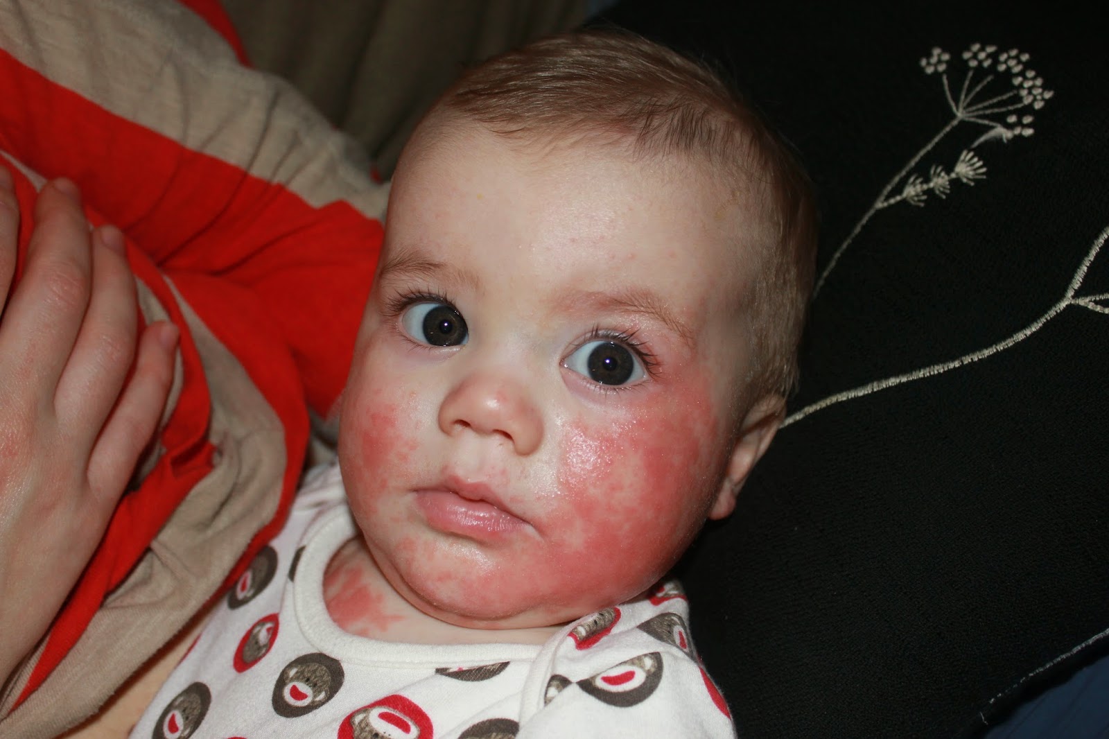 House of Thorns Infant Eczema + Allergies and Why I'm Not Just Your