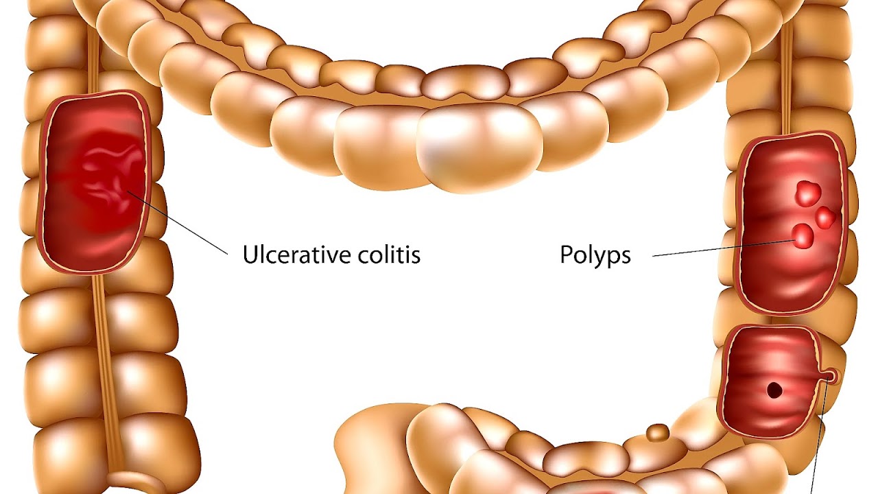New Treatments For Ulcerative Colitis Treat Choices