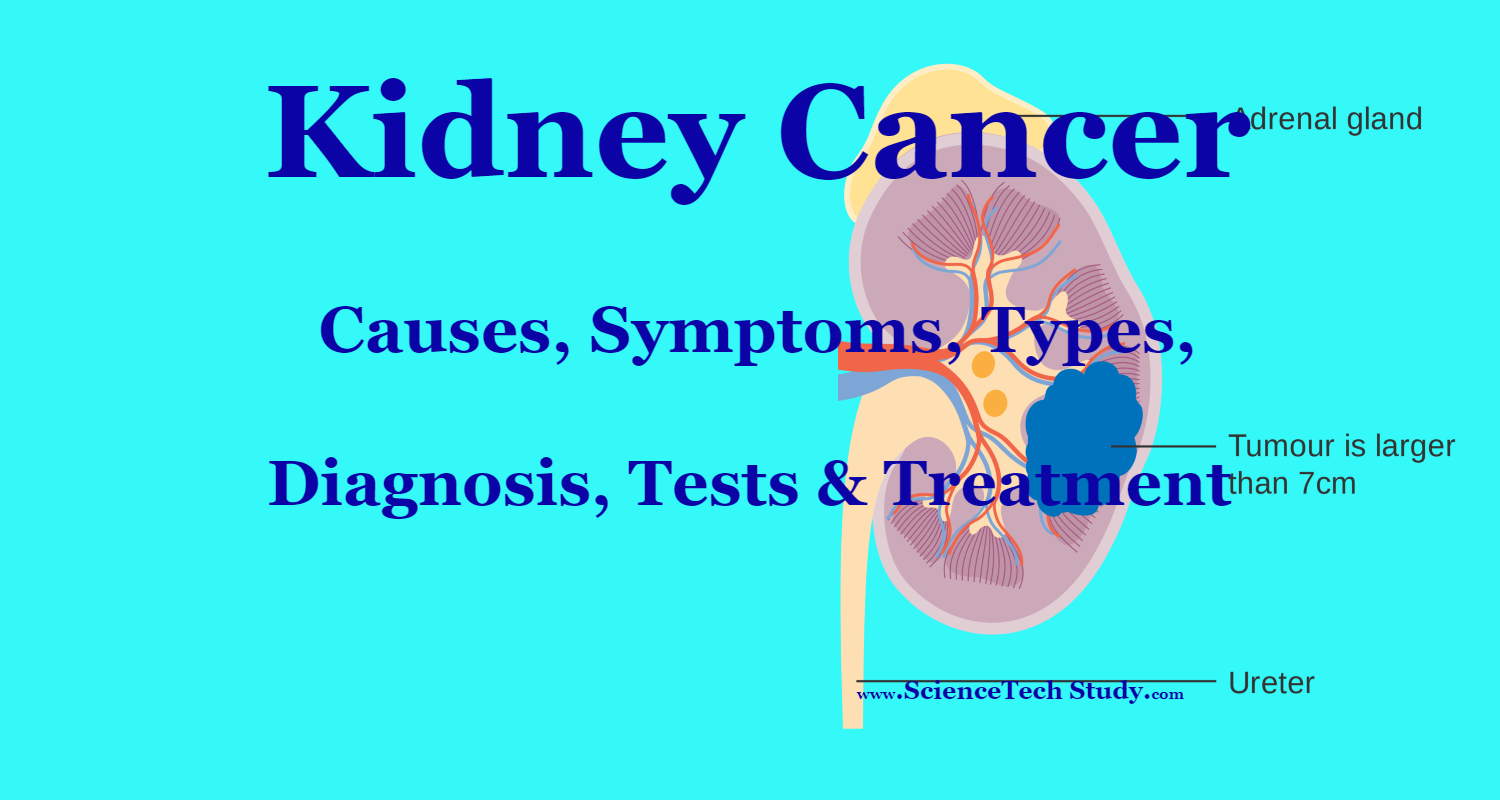 Kidney Cancer - Pictures