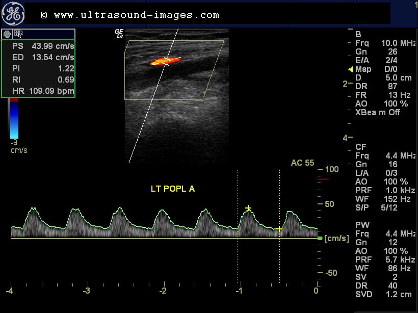 Ultrasound Imaging Color Doppler Study Of Severe Arterial Stenosis