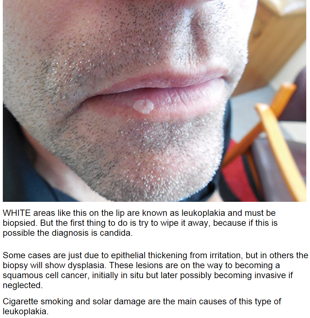 Consultations in Dermatology Leukoplakia lip