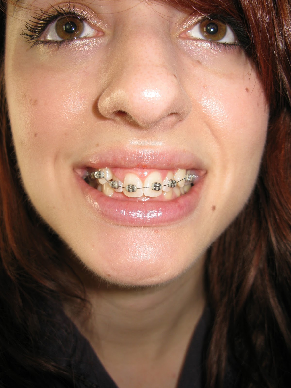 Braces at 22. Just got braces!