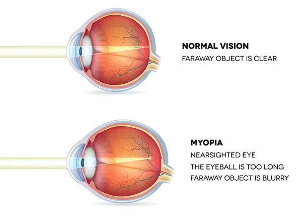 Myopia diagram