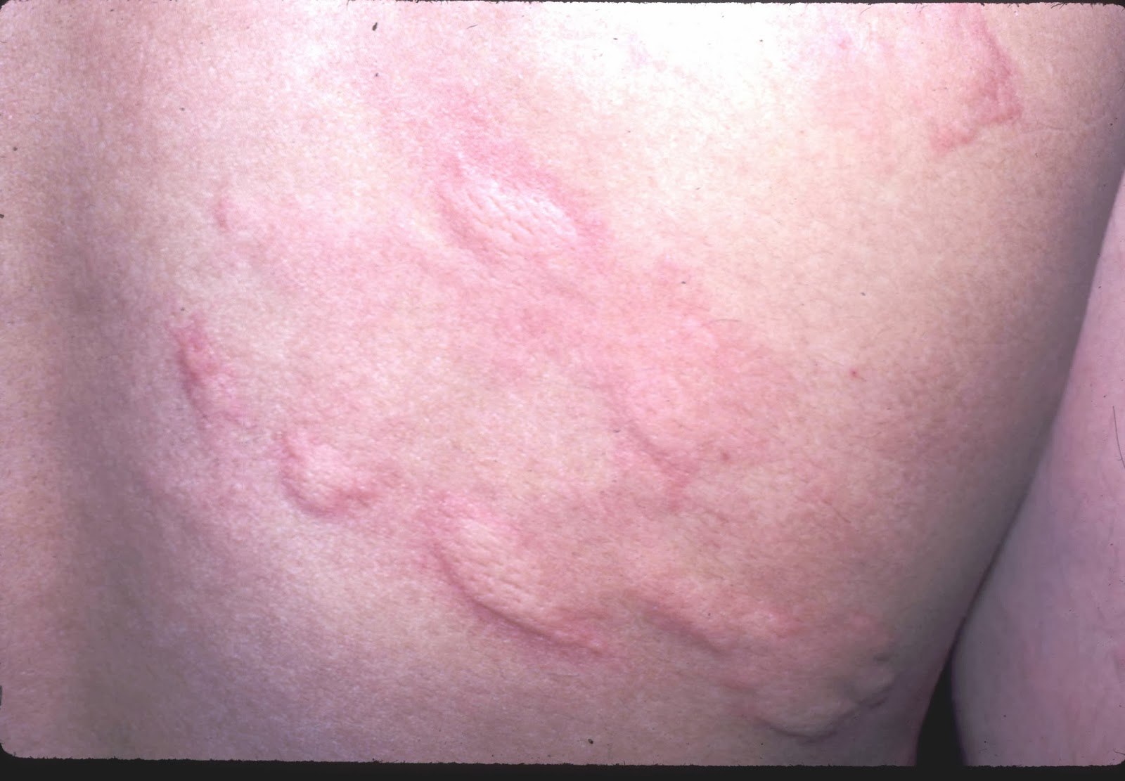 itchy red blotchy rash?? - Dermatology - MedHelp
