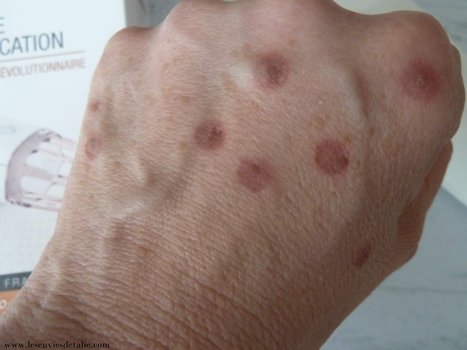 En finir avec les taches brunes avec Cryobeauty mains