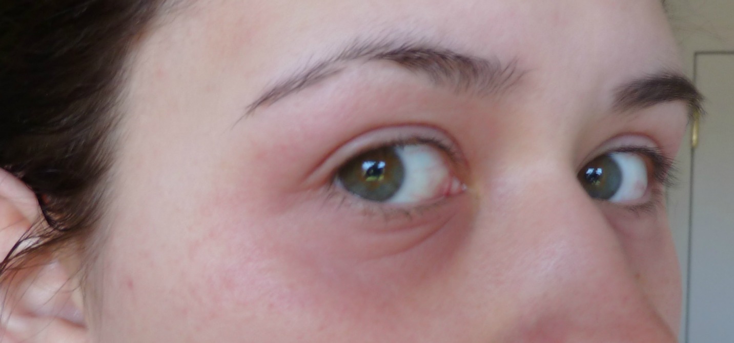 Eyelid contact dermatitis | DermNet New Zealand