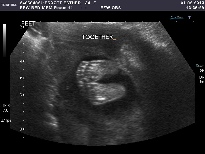 Nine Months of Baby 18 Week Ultrasound Boy or Girl?