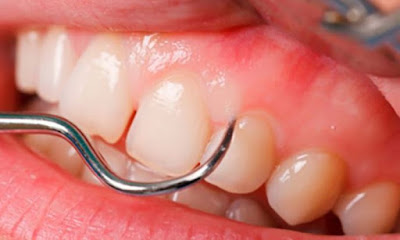 Cách điều trị viêm lợi khi niềng răng 