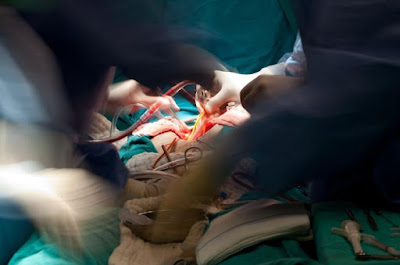 world largest brain tumour removed indian surgeons