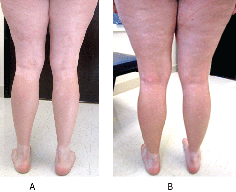 Mejora del vitiligo después del tratamiento del hipotiroidismo-fig-2