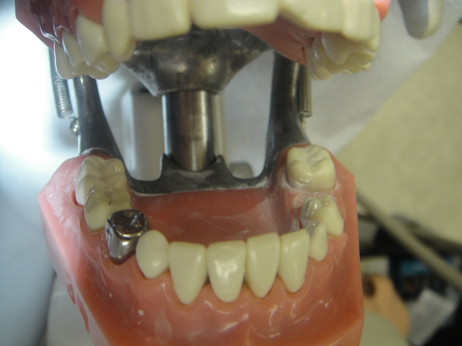 StuDENT Diaries Pedo Stainless Steel Crown