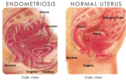 Risiko Persalinan Normal Setelah Operasi Sesar | Endometriosis