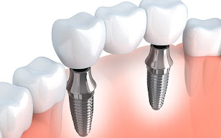 Cách chăm sóc răng Implant sau khi cấy ghép