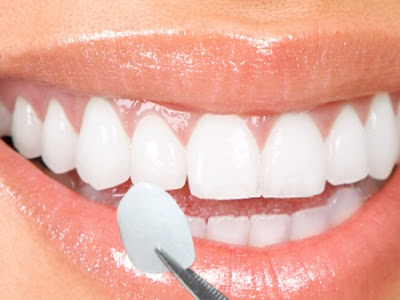 Bọc răng sứ loại nào tốt nhất?