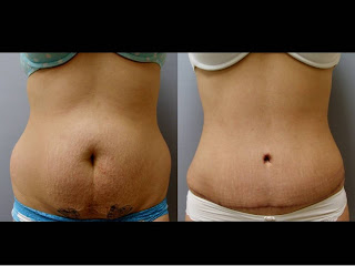 tuck tummy tx antonio san visit houston