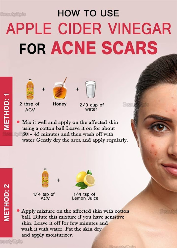 Benefits of Using Apple Cider Vinegar For Acne