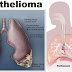 O que é mesotelioma?