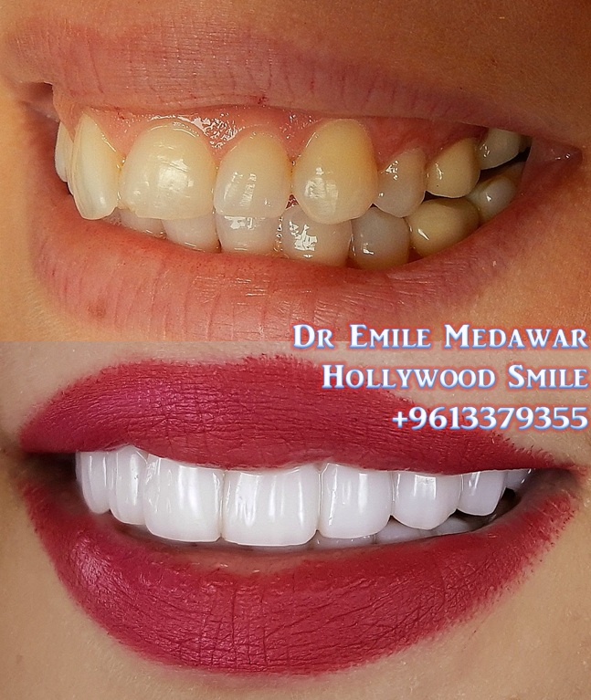 Dr Emile Medawar Smile veneers dubai
