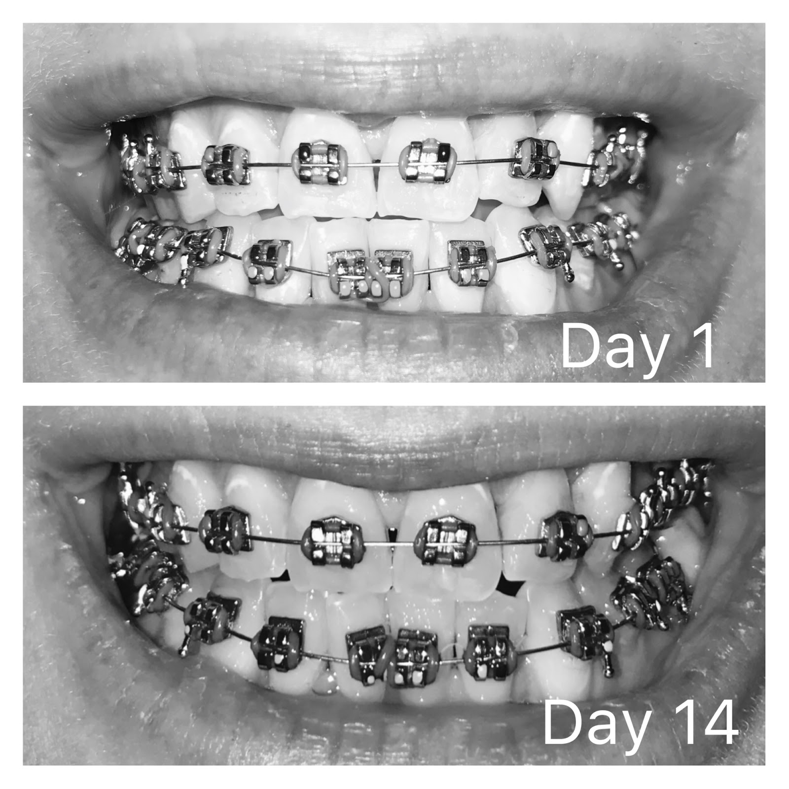 Sarah Says... Day 15, 3 molar bands and metal spacers