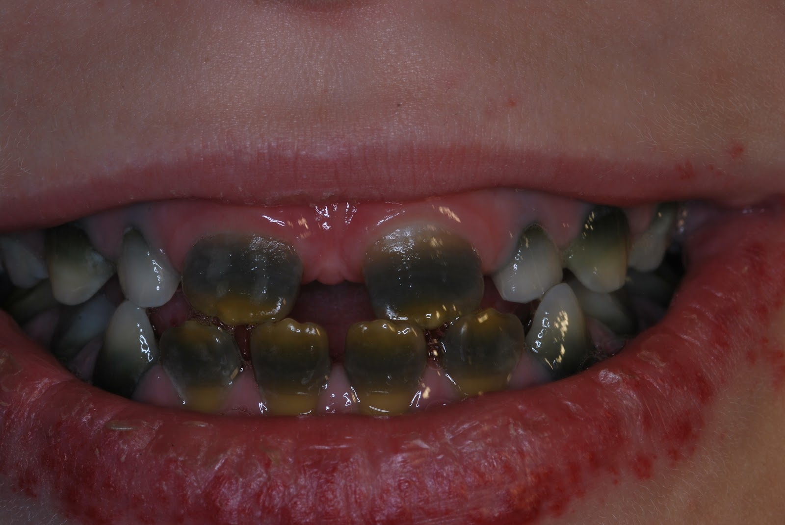peter-s-progress-peter-s-gray-and-brown-striped-teeth