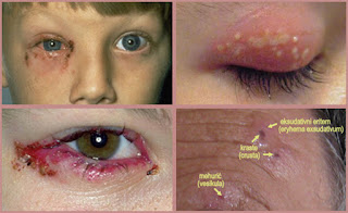 Obat Herpes pada Mata