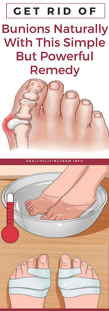 GET RID OF BUNIONS NATURALLY WITH THIS SIMPLE BUT POWERFUL REMEDY