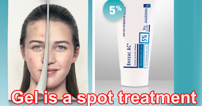 benzac ac spot treatment