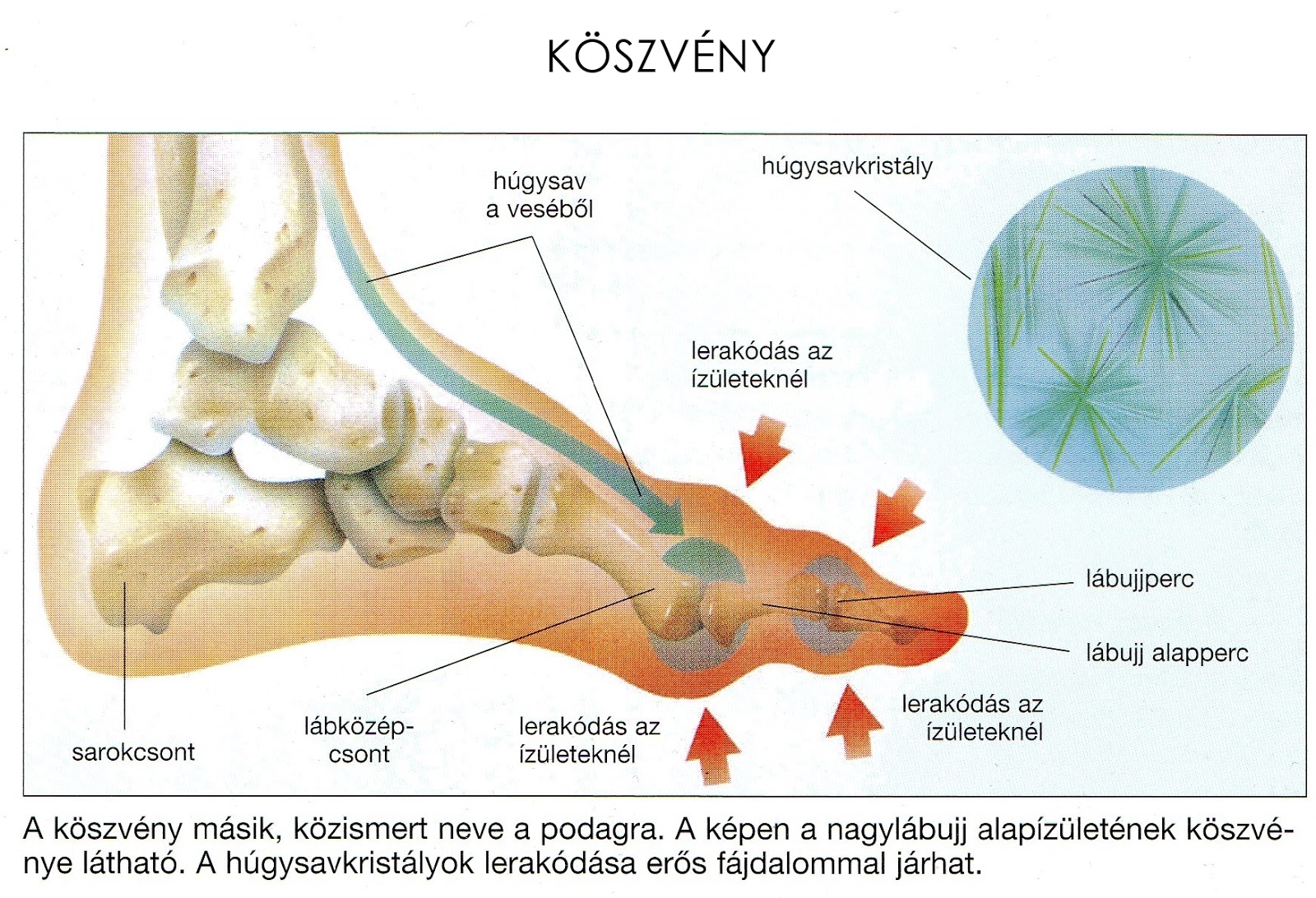 az ízületek nyálkahártyájának gyulladása)