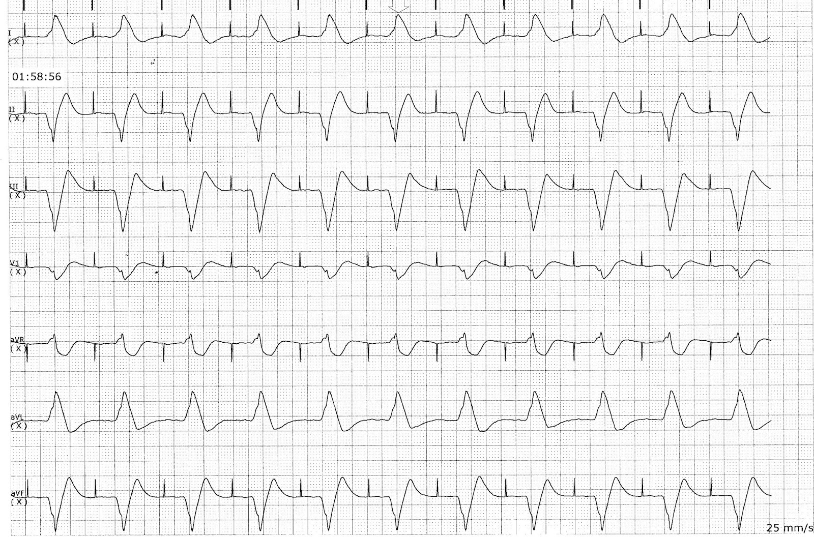 ECG Rhythms Can you recognize death by just looking at telemetry (ECG
