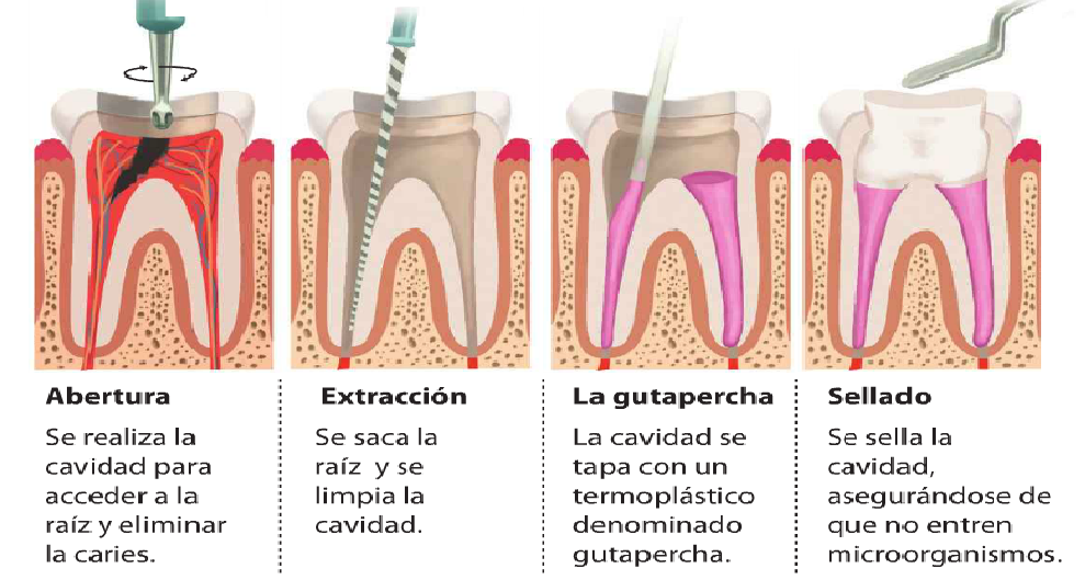 ÉRIKA MODA TRATAMIENTO DE CONDUCTO