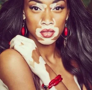 Winnie-Harlow-Model with vitiligo