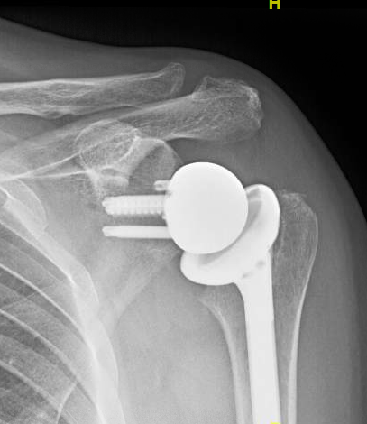 Shoulder Arthritis / Rotator Cuff Tears: causes of Shoulder Arthritis / Rotator Cuff Tears: causes of