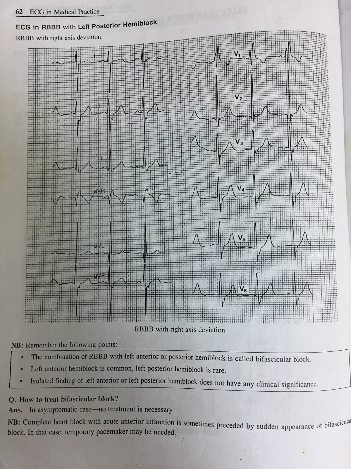 ECG AV DISSOCIATION, RBBB, AND FASCICULAR BLOCK (HEMIBLOCK)