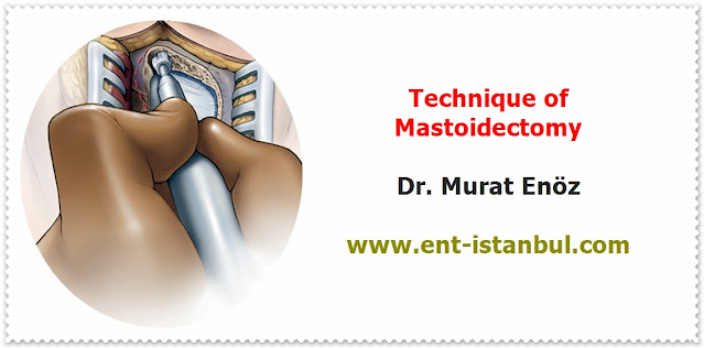 Mastoidectomy Operation,Mastoidectomy Technique,Postoperative Patient Care For Mastoidectomy Operation,Canal Wall Up Mastoidectomy,Mastoidectomy Indications,Mastoidectomy Definition,