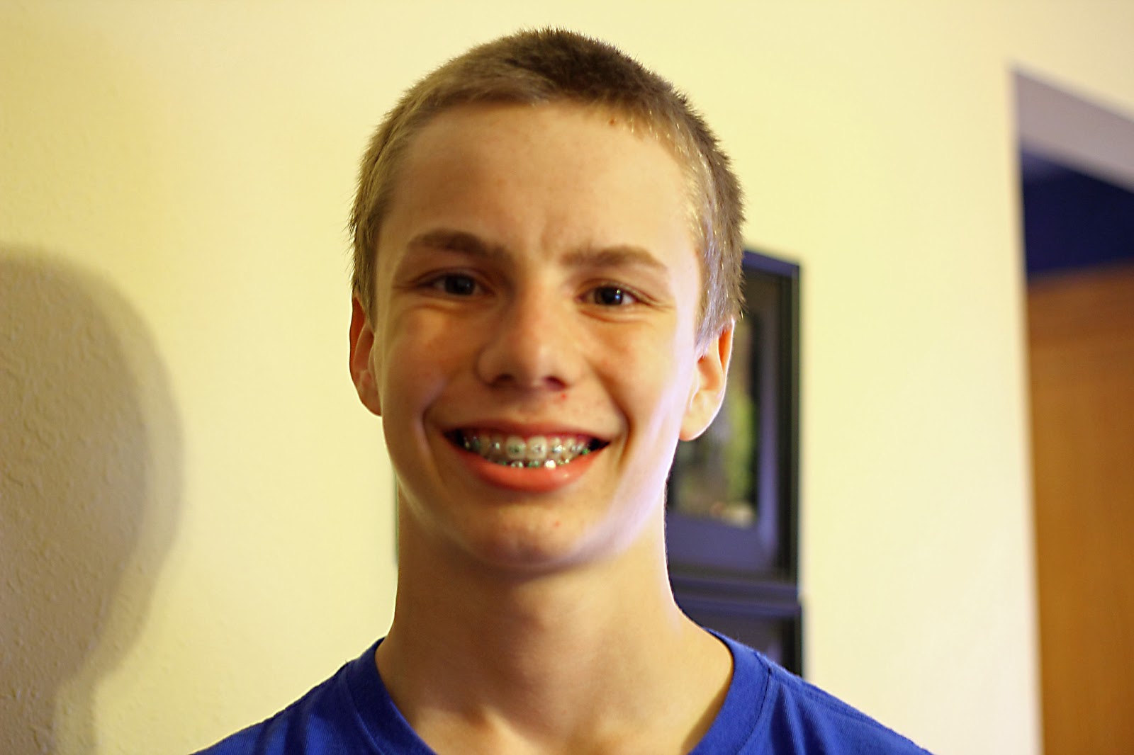 Before And After Braces Before And After Braces Just On Top