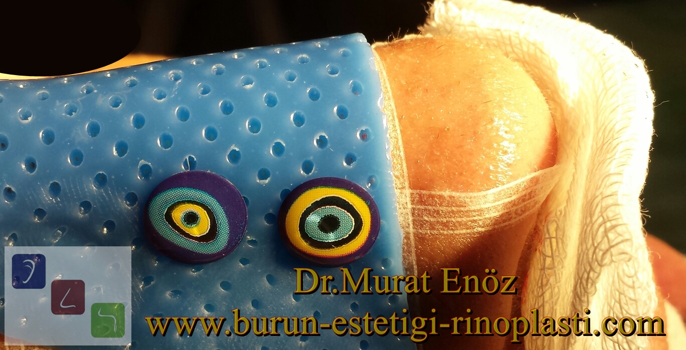 Burun Estetiği Ameliyatı Rehberi 👃 22 Ameliyat Sonrası Burun