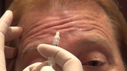 Efektifkah Prosedur Facelift Botox Untuk Mengatasi Penuaan ?