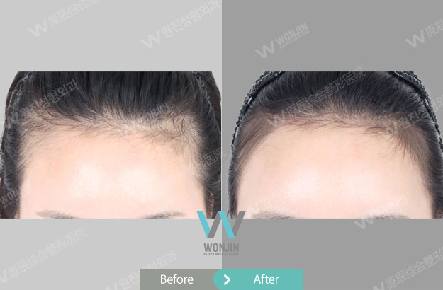 Hair Line Contouring Or Hair Line Corrections Surgery Have More