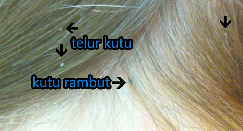 Gaya Hidup Sehari-hari di Sekitar Kita: Cara Mnghilangkan Kutu Di