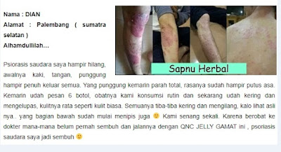Obat Karurawit / Karurawit Herbal Obat Karurawit / Karurawit Herbal