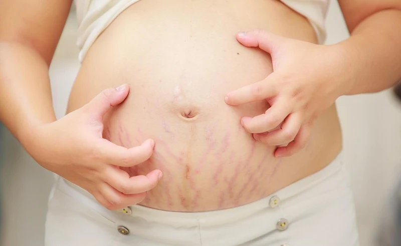 Colestase Intra-Hepática da Gravidez: Sintomas e Tratamento