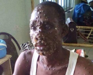 Seven people recover from Monkeypox In Bayelsa State