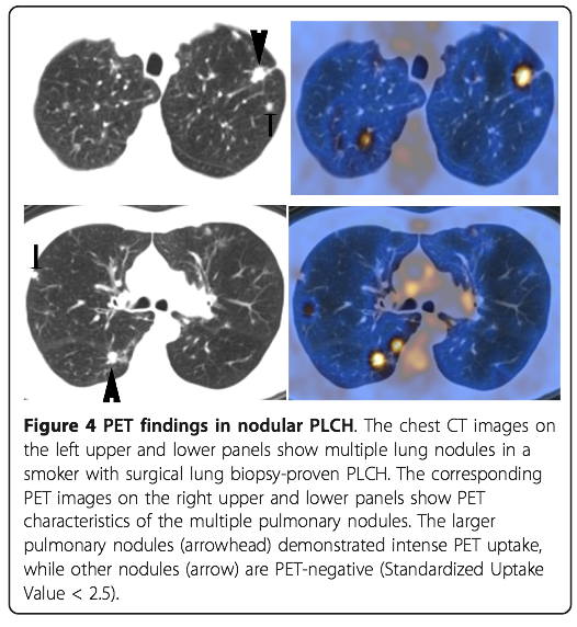 Hospitalist なんでも無い科医の勉強ノート Langerhans Cell Histiocytosis(LCH) ラングハンス細胞組織球症 Hospitalist なんでも無い科医の勉強ノート Langerhans Cell Histiocytosis(LCH) ラングハンス細胞組織球症