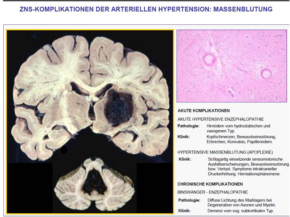 WORDS AND PICTURES Zerebrale Mikroangiopathie WORDS AND PICTURES Zerebrale Mikroangiopathie