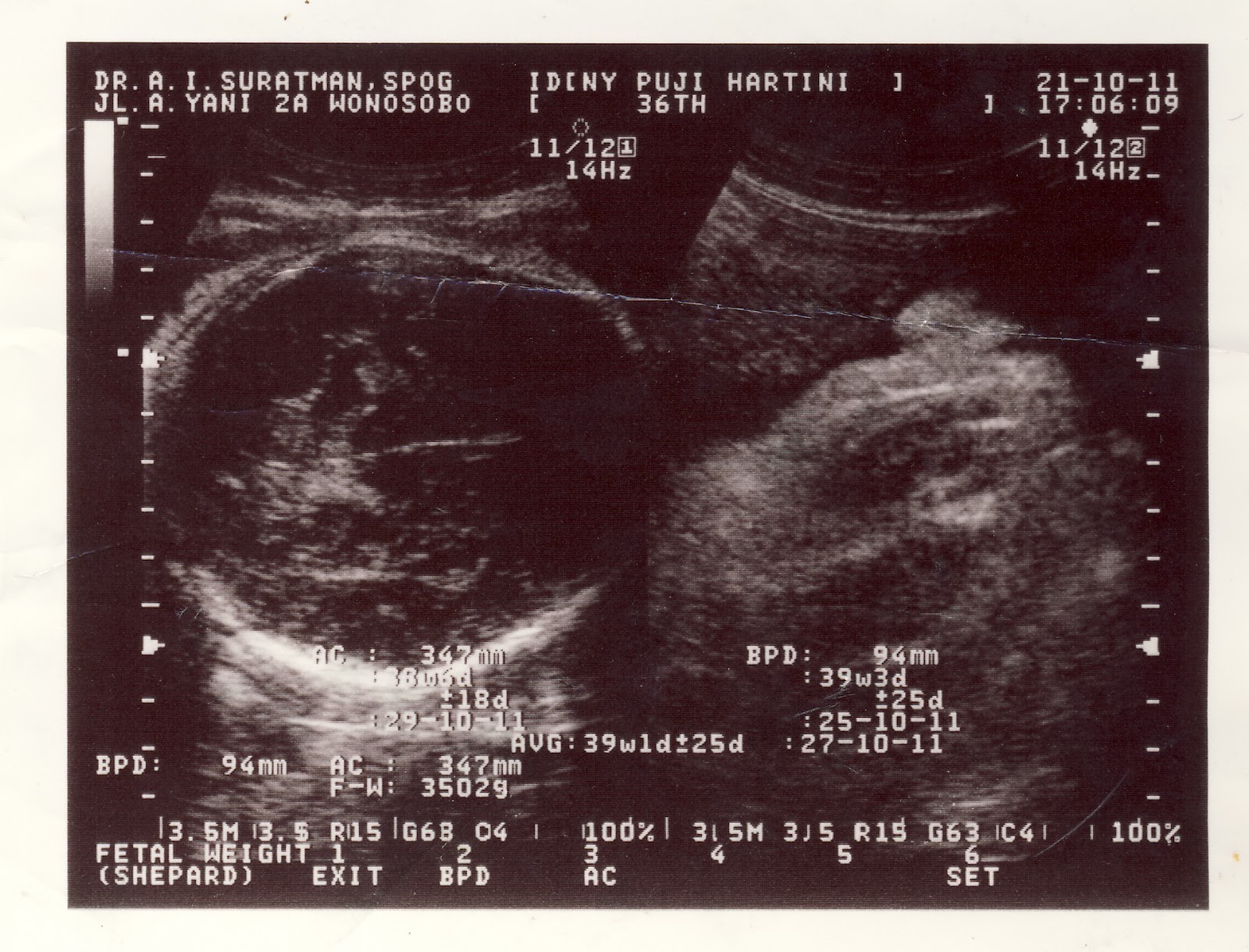 everything and anything: membaca hasil USG