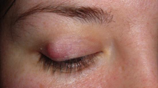 hot compress for cyst on eyelid