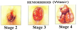 Cara mengempeskan benjolan ambeien luar, jual obat untuk mengobati wasir di sorong selatan, penyakit wasir disebabkan karena apa, obat untuk penyakit wasir parah, obat wasir di yalimo, obat penyakit wasir krim, jual obat wasir di paringin, atasi ambeien atau wasir dengan bawang putih, apakah penyakit ambeien atau wasir bisa disembuhkan, jual obat untuk penyakit wasir di ungaran, obat ambeyen parah