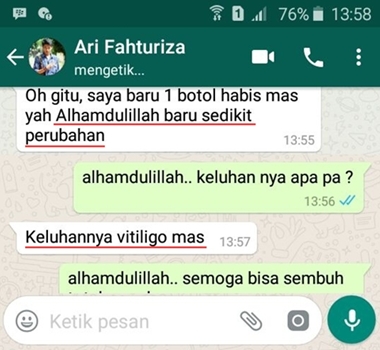 Cara Cepat Menghilangkan Vitiligo dengan Ampuh Cara Cepat Menghilangkan Vitiligo dengan Ampuh