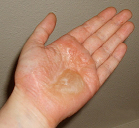 dyshidrotic eczema