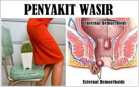 Foto Nama-nama Obat Ambeien Di Apotik Ampuh Tanpa Operasi